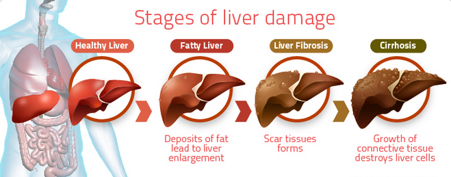 non-alcoholic-fatty-liver-disease-all-medica-global